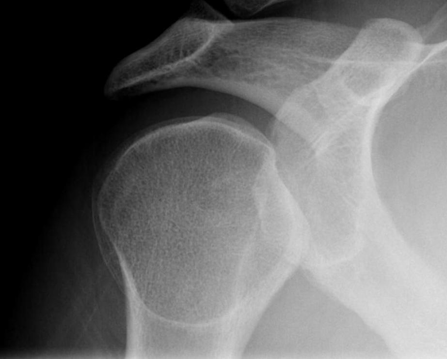 Posterior Shoulder Dislocation Light Bulb Sign